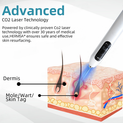 Hermsa® High-End Non-Invasive Laser Mole & Wart Removal Pen