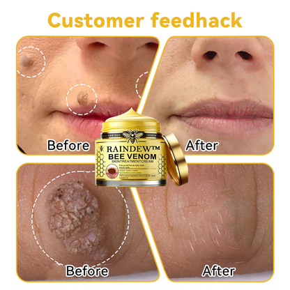 [Winter-Skincare] Raindew™ Bee Venom Skin Treatment Cream（AAD RECOMMENDED FROM US）
