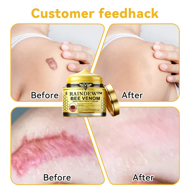 [Winter-Skincare] Raindew™ Bee Venom Skin Treatment Cream（AAD RECOMMENDED FROM US）