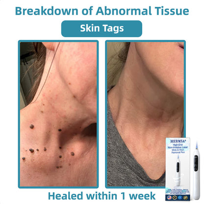 Hermsa® High-End Non-Invasive Laser Mole & Wart Removal Pen